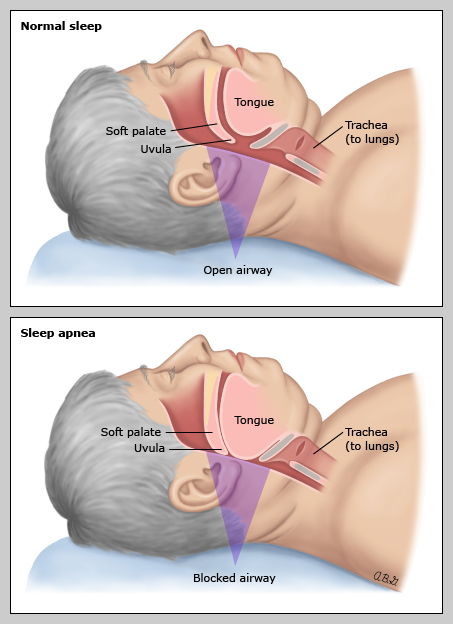 This is a figure titled Airway in a person with sleep apnea. Legend: Normally, when a person sleeps, the airway remains open, and air can pass from the nose and mouth to the lungs. In a person with sleep apnea, parts of the throat and mouth drop into the airway and block off the flow of air. This can cause loud snoring and interrupt breathing for short periods.