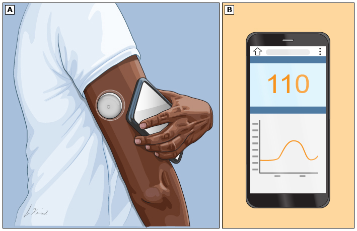 This is a figure titled Continuous glucose monitoring. Legend: This is an example of an "intermittently scanned" continuous glucose monitoring ("CGM") device. It works with a smartphone app. You hold your phone over the sensor (A), and it gives you information about your blood sugar level (B). "Real-time" CGM devices automatically and wirelessly send glucose readings to a receiver or smartphone. With these devices, you do not need to scan the sensor to get a reading.