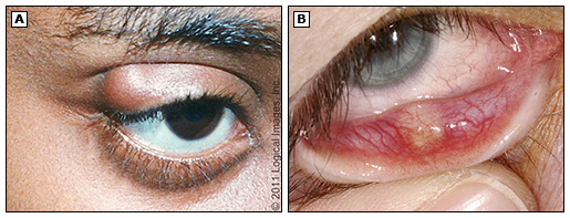 Chalazion in the eyelid