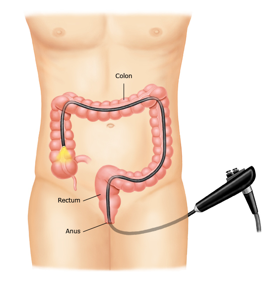 This is a figure titled Colonoscopy. Legend: During a colonoscopy, you lie on your side or back and the doctor puts a thin tube with a camera into your anus (from behind). Then, the doctor advances the tube into the rectum and colon. The camera sends pictures from inside your colon to a screen.