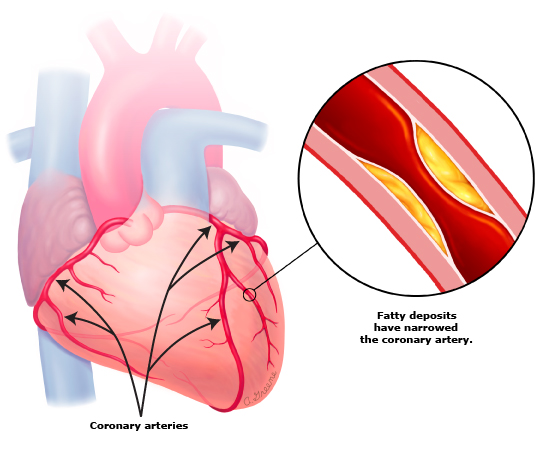 This is a figure titled Coronary heart disease. Legend: In people with coronary heart disease, the coronary arteries get clogged with fatty deposits called plaques.