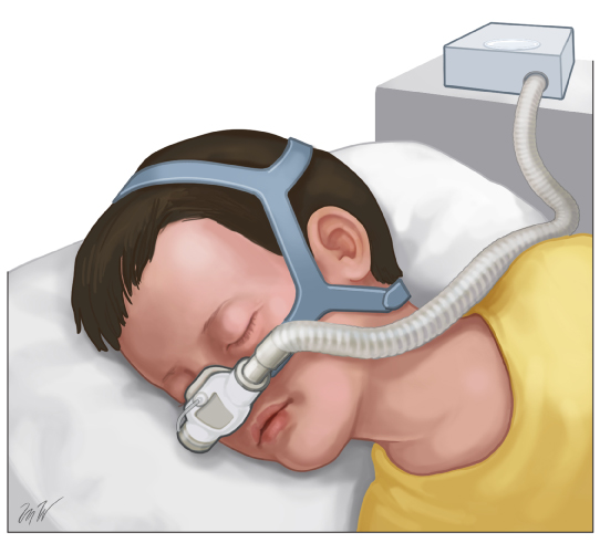 This is a figure titled Positive airway pressure ("PAP") for obstructive sleep apnea. Legend: The PAP mask gently blows air into the child's nose while they sleep. It puts just enough pressure on their airway to keep it from closing.