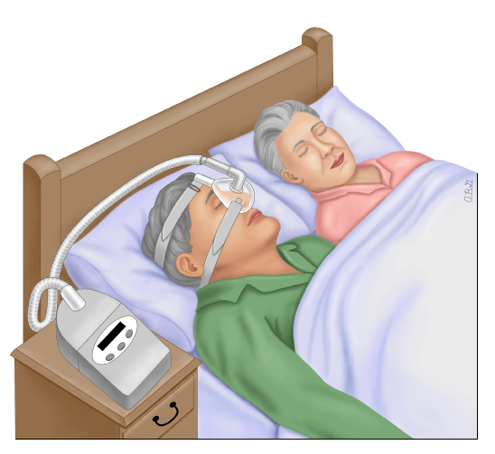 This is a figure titled Positive airway pressure ("PAP") for obstructive sleep apnea. Legend: The PAP mask gently blows air into your nose while you sleep. It puts just enough pressure on your airway to keep it from closing. This mask fits over just the nose. Other PAP devices have masks that fit over the nose and mouth.