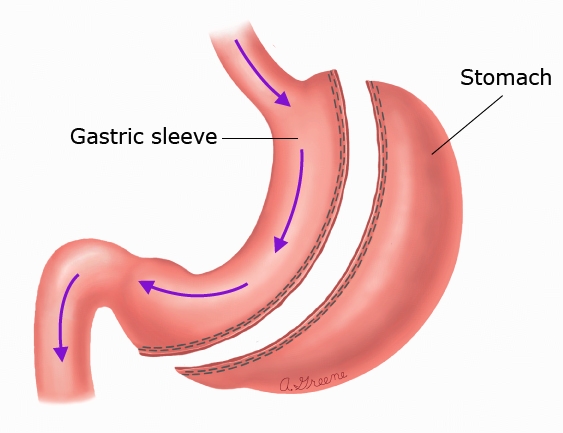 This is a figure titled Gastric sleeve. Legend: Gastric sleeve is a type of weight loss surgery. The doctor removes a large portion of the stomach and leaves a narrow tube that looks like a sleeve. The arrows show the path food takes through the gastric sleeve after surgery.