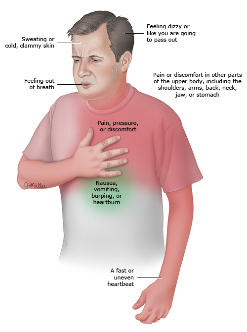 This is a figure titled Heart attack symptoms. Legend: This picture shows the main symptoms of a heart attack. People who are having a heart attack often have only some of these symptoms. The pain, pressure, and discomfort caused by a heart attack mostly affect the left side of the body, but can also affect the right. Women are more likely than men to have symptoms other than chest pain. But chest pain or discomfort is the most common symptom of a heart attack in both women and men. If you think that you are having a heart attack, call for an ambulance (in the US and Canada, call 9-1-1). Do not try to get yourself to the hospital.