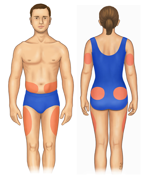 This is a figure titled Where to give an insulin shot. Legend: The shaded areas can be used for insulin shots. You should change areas so that you do not use the same area each time. Insulin gets into the blood more quickly when injected into the belly, as compared with the arms or legs.