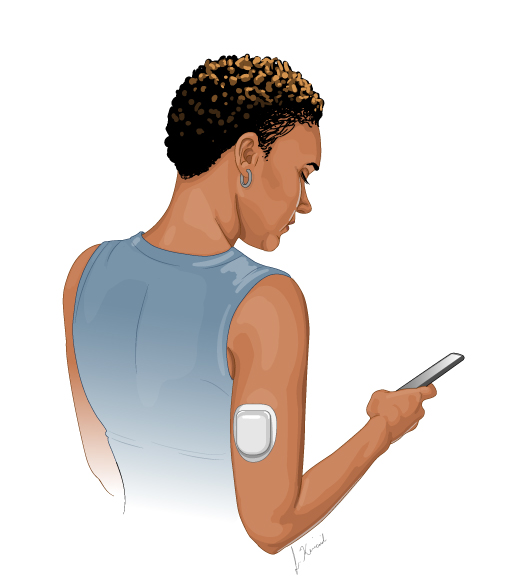 An insulin pump patch attached to the back of a person's arm.