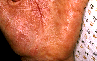 Irritant contact dermatitis