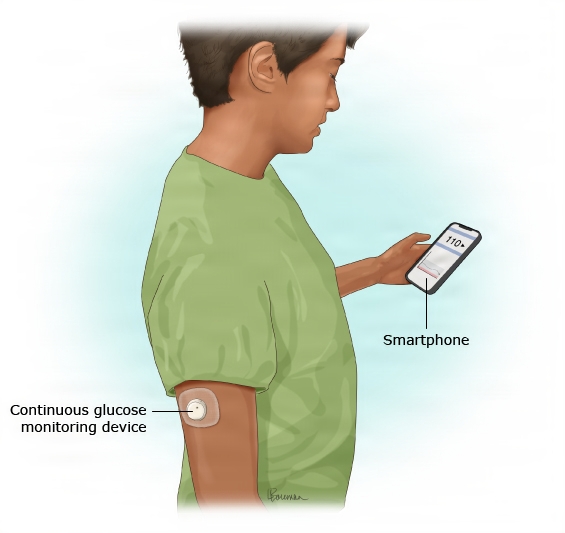 This is a figure titled Real-time continuous glucose monitoring. Legend: This is an example of a "real-time" continuous glucose monitoring ("CGM") device. It automatically checks your sugar level every few minutes. In this drawing, the device sends the results to a smartphone. Some devices send the results to a "receiver" device.