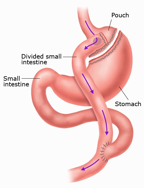 This is a figure titled Roux-en-Y gastric bypass. Legend: Roux-en-Y gastric bypass, or "RYGB," is a type of weight loss surgery. The doctor closes off part of the stomach, leaving only a small pouch for food. Then, they connect the stomach pouch to the middle part of the small intestine. This lets food "bypass" (go around) part of the stomach and small intestine. With RYGB, the stomach pouch is connected to the divided small intestine. The arrows show the path food takes through the pouch and divided small intestine after surgery.