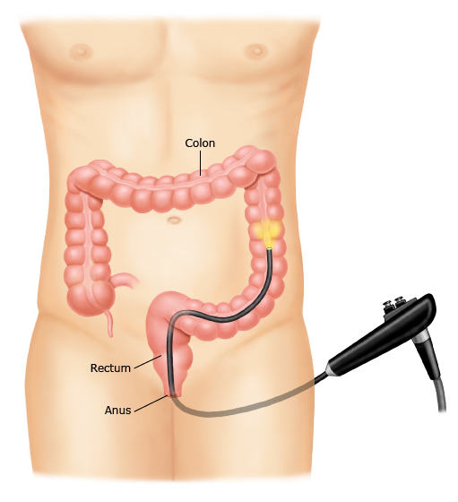 This is a figure titled Sigmoidoscopy. Legend: During a sigmoidoscopy, you lie on your side and the doctor puts a thin tube with a camera into your anus (from behind). Then, they advance the tube into your rectum and the last part of your colon. The camera sends pictures from inside your colon to a TV screen.