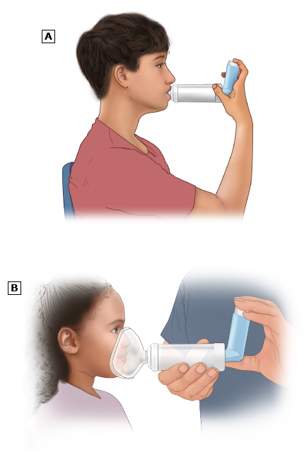 This is a figure titled Using a valved holding chamber or other spacer device. Legend: Most children with asthma use an inhaler with a valved holding chamber or other spacer device. This is a device that attaches to the inhaler's mouthpiece. The devices shown in this figure are both valved holding chambers. (A) When the child presses down on the canister, a puff of medicine is released into the valved holding chamber/spacer. Then, the child breathes it in. (B) Some valved holding chambers/spacers come with a face mask. If your child's valved holding chamber/spacer has a mask, hold it snugly over their mouth and nose. Then, press down on the canister to release the medicine into the valved holding chamber/spacer. The child can then breathe it in.
