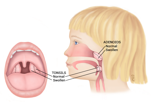 This is a figure titled Tonsils and adenoids. Legend: The tonsils and adenoids are areas of soft tissue in the back of the throat. If they get swollen, they can keep a child from breathing normally through the mouth or nose.