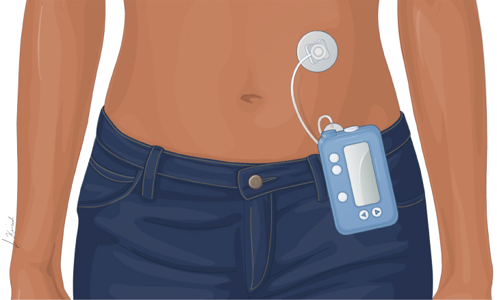 This is a figure titled Traditional insulin pump. Legend: This insulin pump is connected to a tube that is inserted under the skin. The pump containing insulin can be attached to your clothing or carried in your pocket.