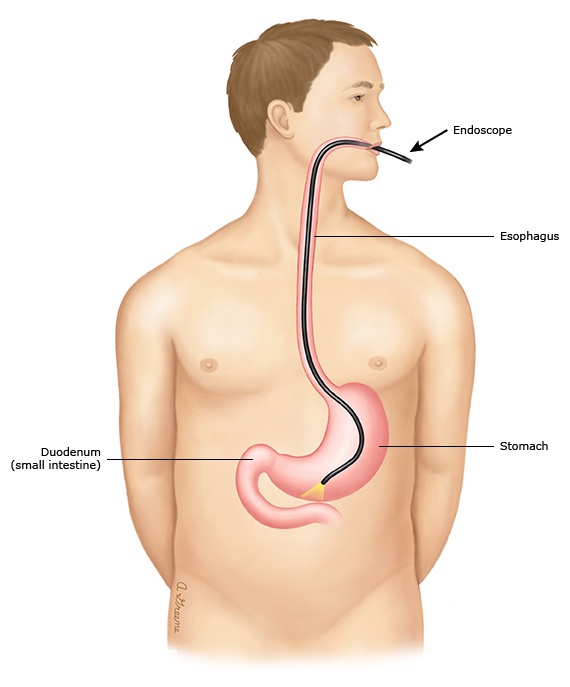 This is a figure titled Upper endoscopy. Legend: During an upper endoscopy, you lie down and the doctor puts a thin tube with a camera and light on the end (called an endoscope) into your mouth and down into your esophagus, stomach, and duodenum (the first part of your small intestine). The camera sends pictures from inside your body to a screen. That way, your doctor can see the inside of your esophagus, stomach, and duodenum.