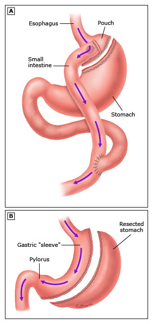 This is a figure titled Weight loss surgery. Legend: These drawings show how the most common weight loss surgeries work. Panel A shows a gastric bypass, and panel B shows a gastric sleeve.